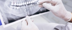Can Root Canal Treatment Cause Cancer?